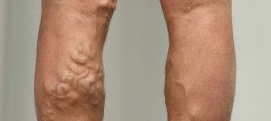 разширени вени на краката