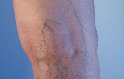 разширени вени по краката при жените