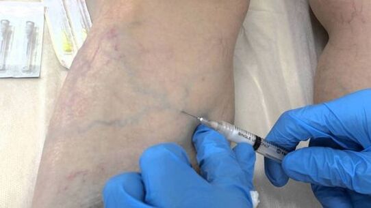 склеротерапия за разширени вени на краката при жените